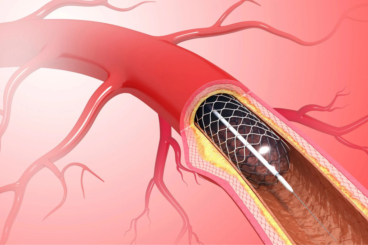 Coronary Angioplasty
