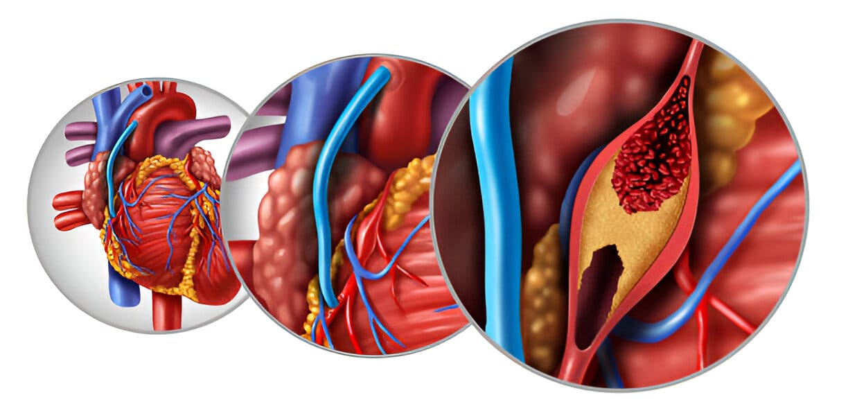 Bypass Procedure