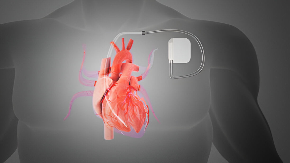 pacemaker implant in human creative