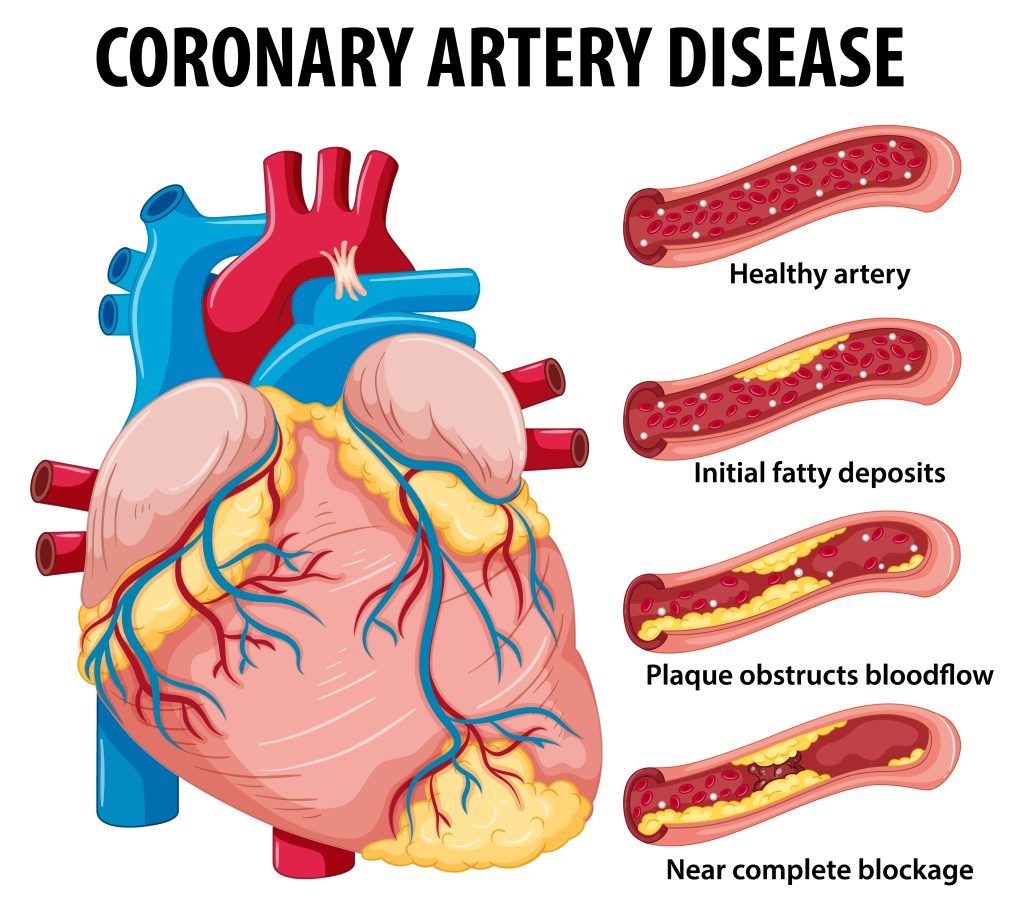 Coronary Artery Disease for heart surgery, Infographic illustration