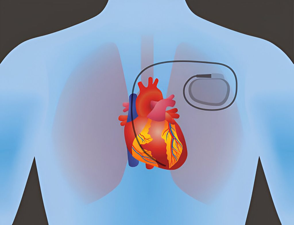 pacemaker in heart illustration