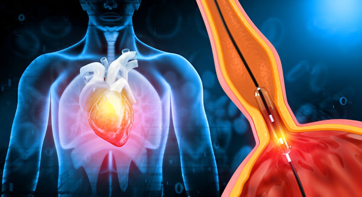 illustration of interventional cardiology