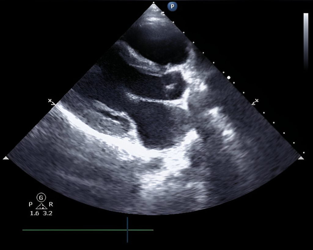 echocardiogram scan