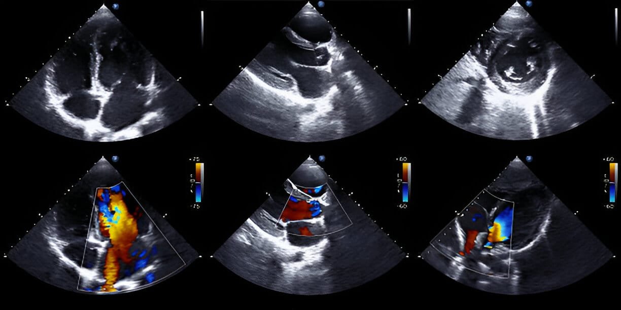 2d echocardiography