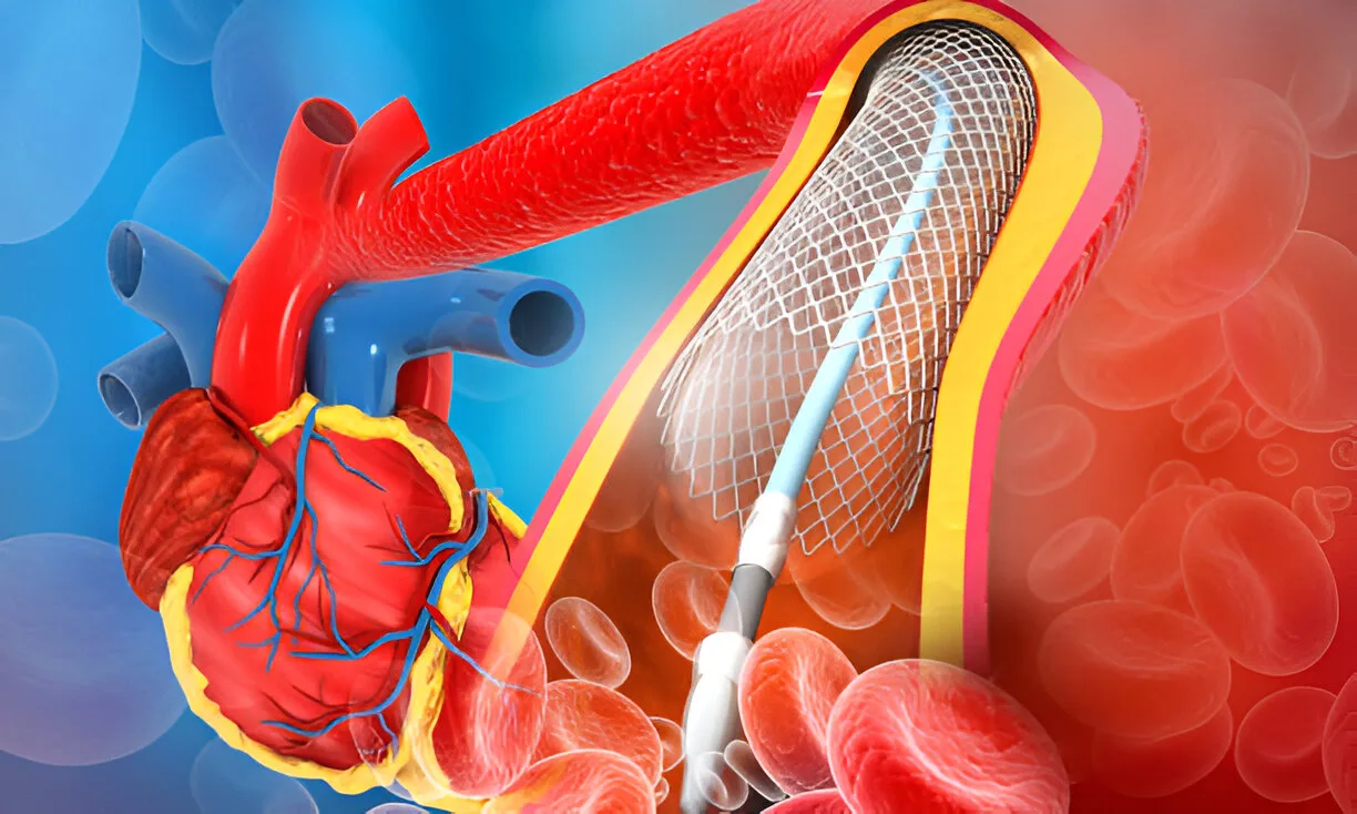 stent placement
