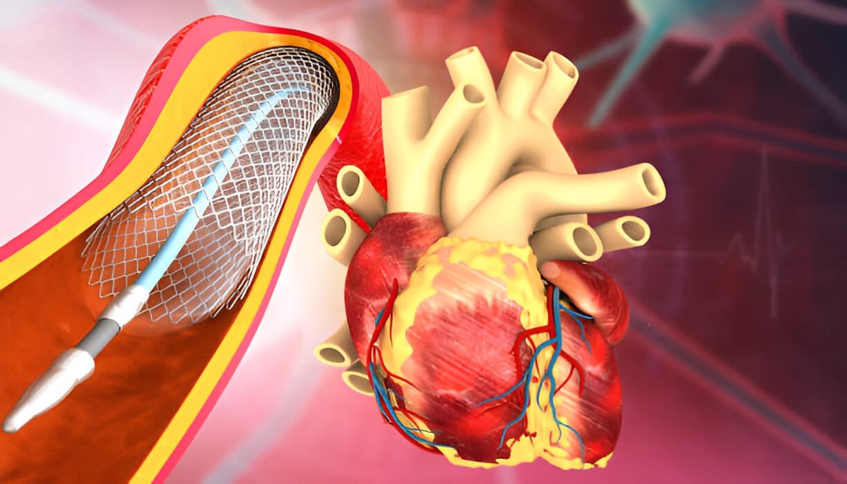 Human heart with angioplasty