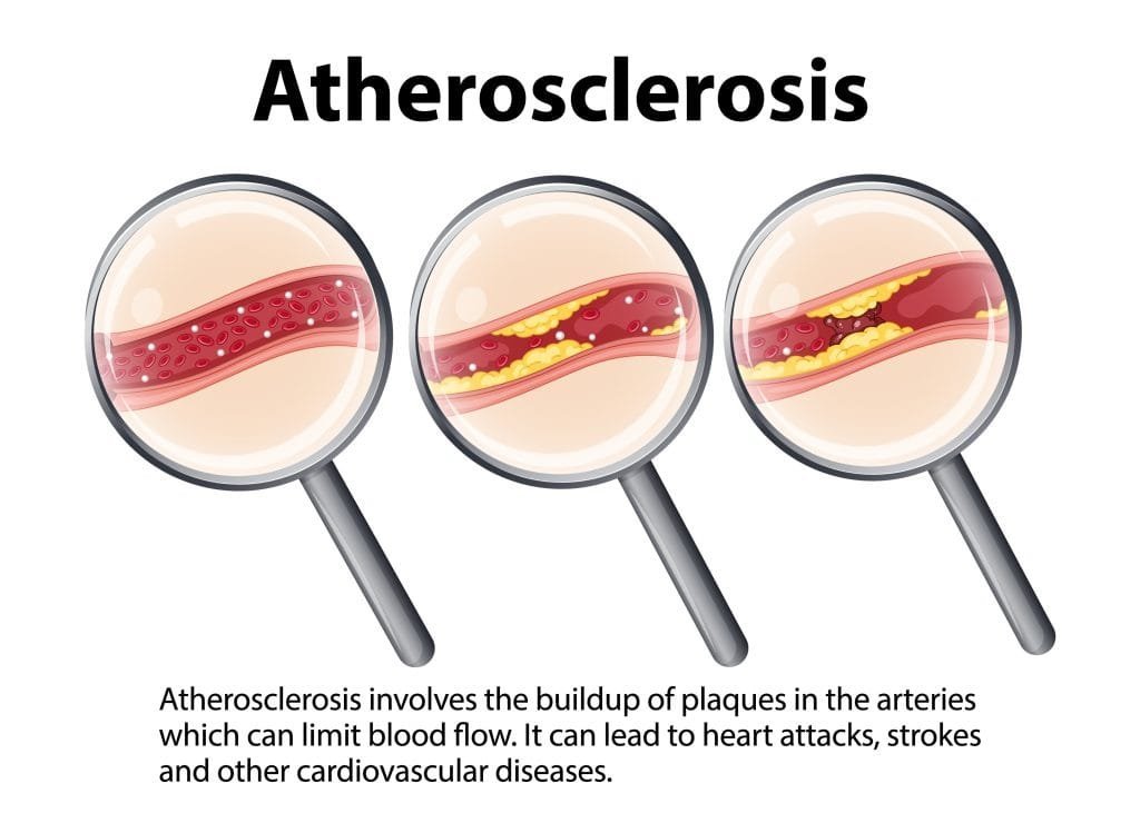 Atherosclerosis