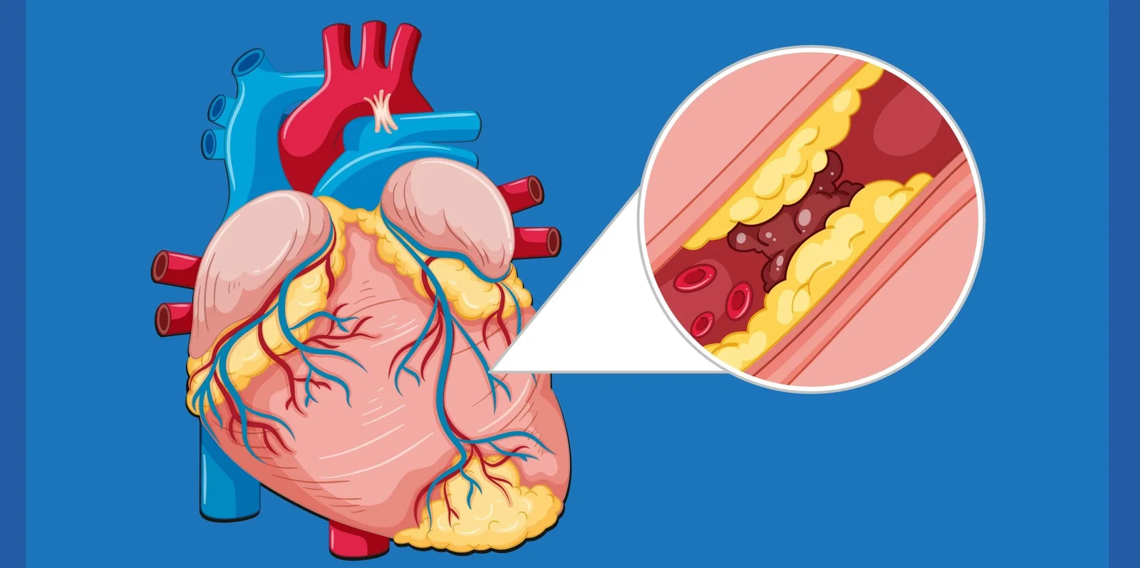heart-blockage