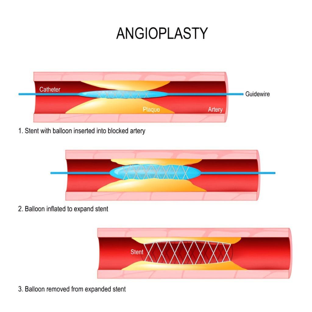 Coronary Angioplasty