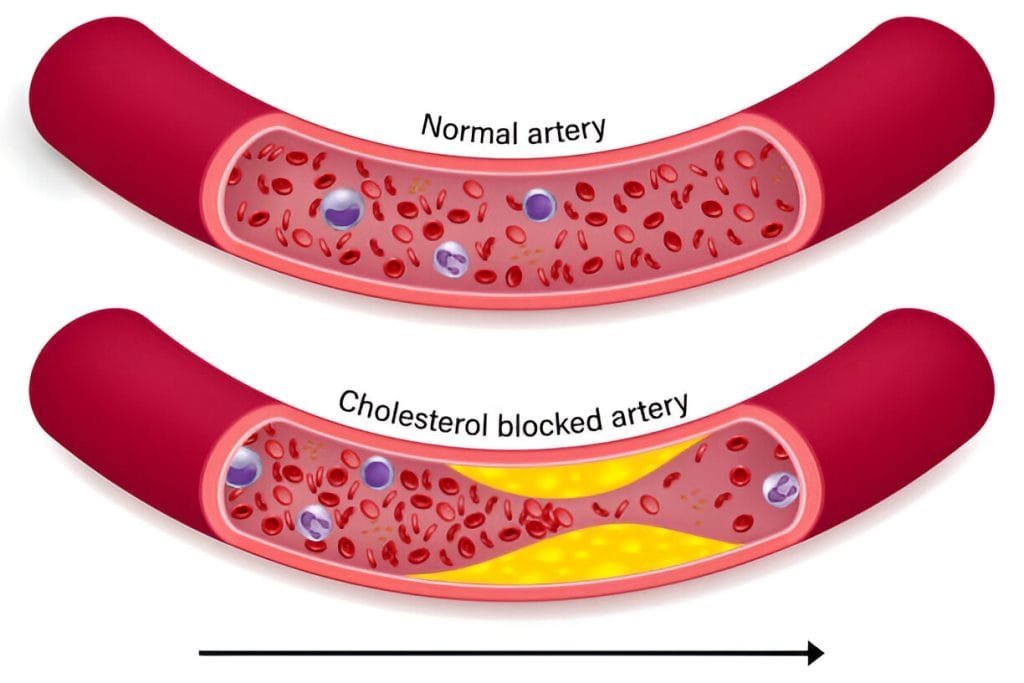 Normal artery and cholesterol blocked artery