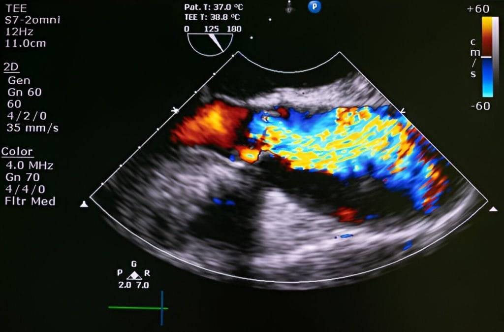 Echocardiogram