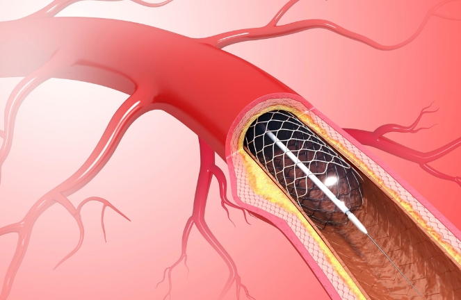 Heart Stent